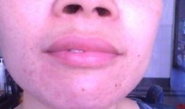 吃瓜之后唇边痒,揭秘背后的健康密码