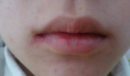 吃白瓜嘴角疼,揭秘瓜果食用小贴士