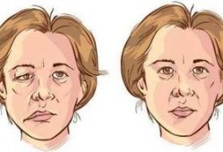 面瘫可以吃角瓜吗,营养滋补助康复